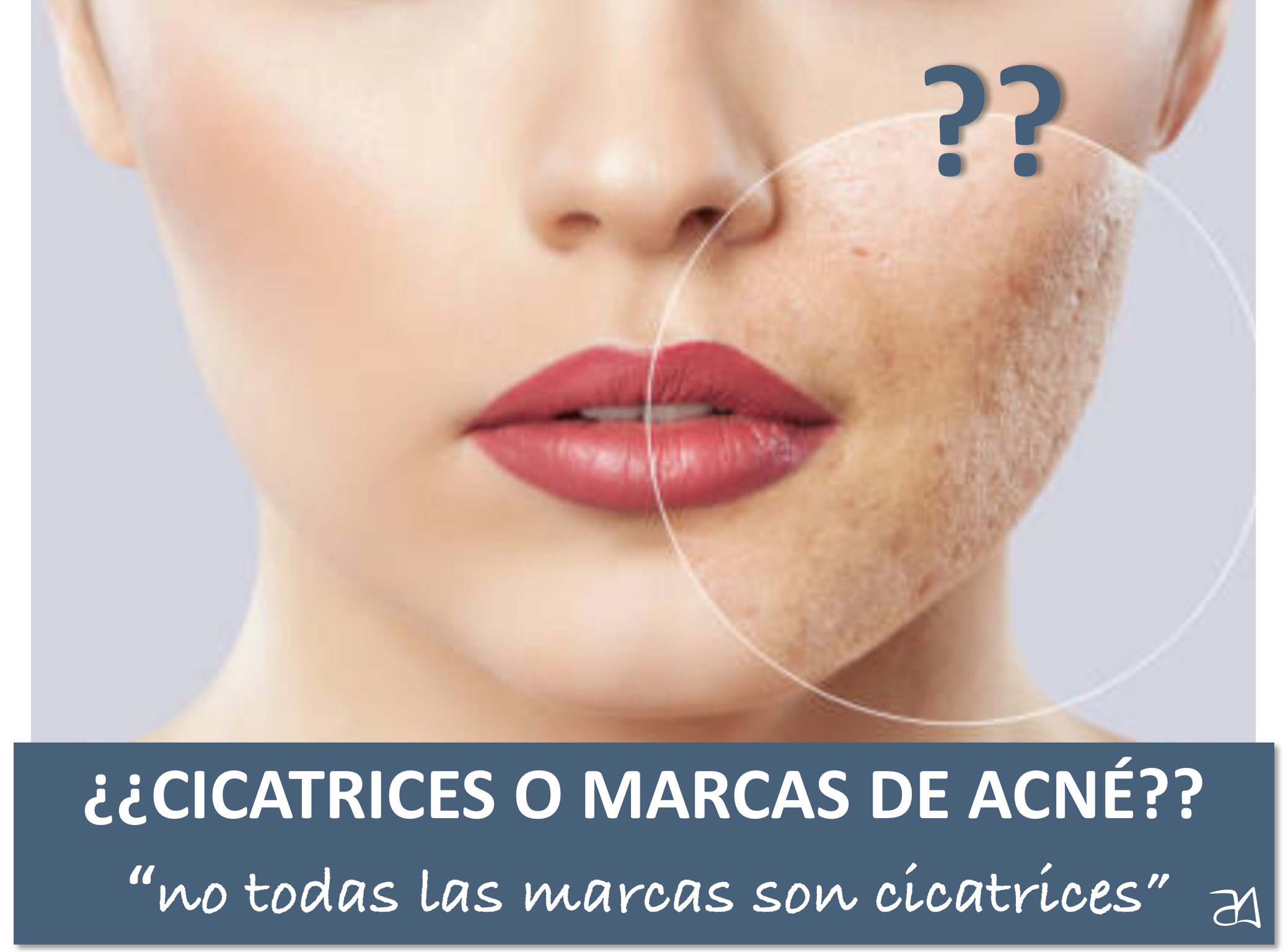 Cicatrices o marcas de acné