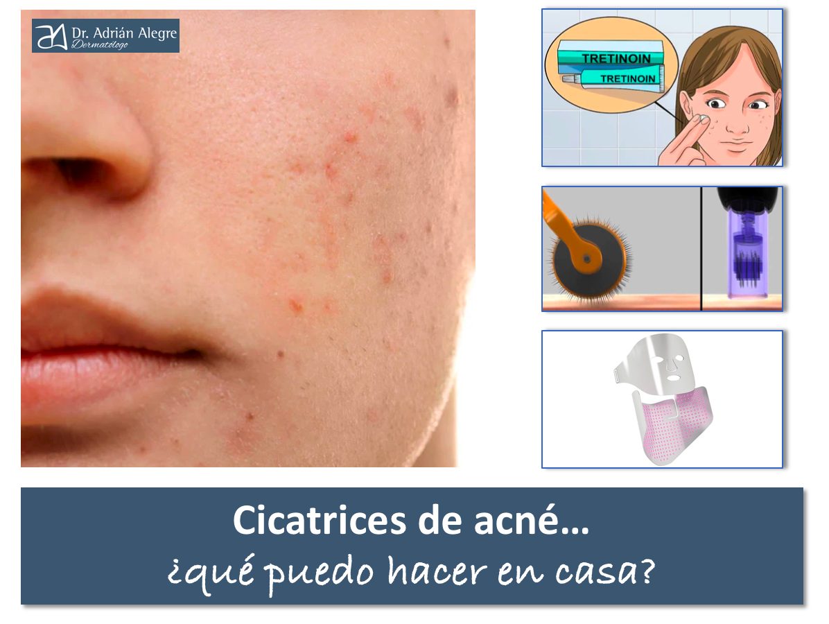 Tratamiento en casa cicatrices de acné