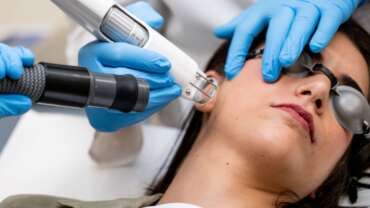 Tratamiento del melasma con láser