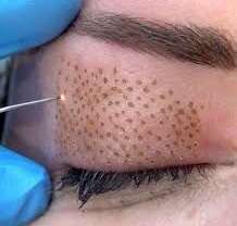 Diferencias entre el resurfacing periocular con Plasma Pen y láser CO2 fraccionado