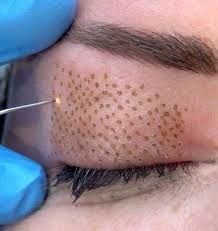 Diferencias entre el resurfacing periocular con Plasma Pen y láser CO2 fraccionado